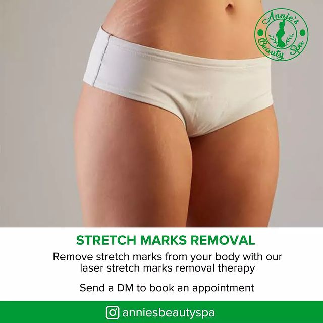 STRETCH MARKS REMOVAL